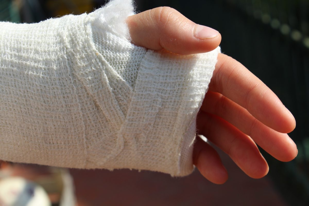 a fractured hand wrapped in bandage